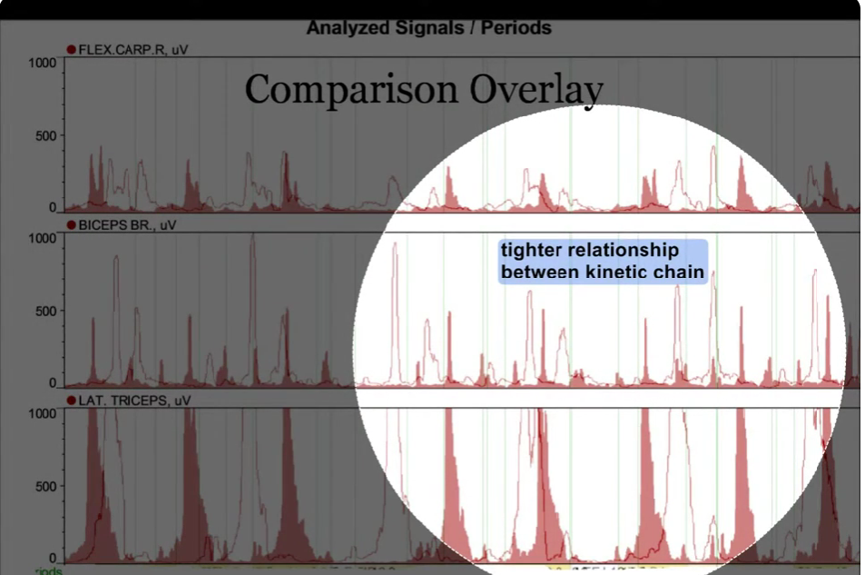 sEMG data showing muscle firing patterns changing after neuro-learning sessions